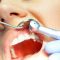 studio-dentistico-giuseppe-gualtieri-crotone-Endodonzia-slide-1